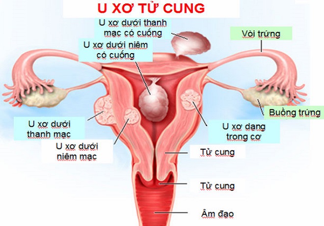Anh 7 U xo tu cung - Dấu hiệu mang thai có đau bụng dưới không và lời giải đáp của chuyên gia